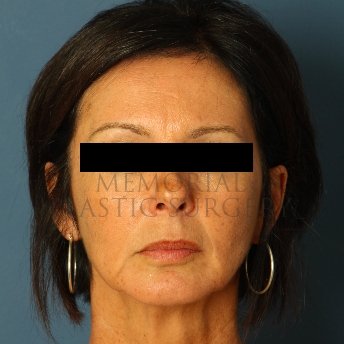 A front view before photo of patient 236 that underwent Face Lift procedures at Memorial Plastic Surgery