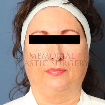 A front view before photo of patient 235 that underwent Face Lift procedures at Memorial Plastic Surgery