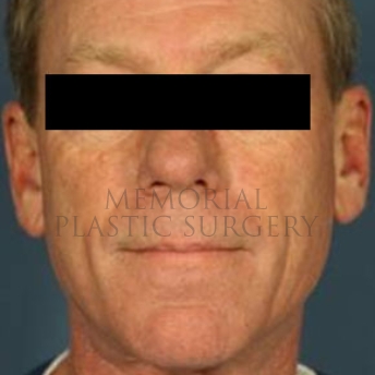 A front view before photo of patient 180 that underwent Face Lift procedures at Memorial Plastic Surgery