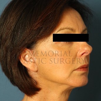 A oblique view after photo of patient 236 that underwent Face Lift procedures at Memorial Plastic Surgery