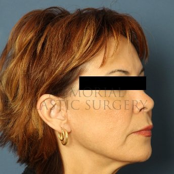 A oblique view after photo of patient 234 that underwent Face Lift procedures at Memorial Plastic Surgery