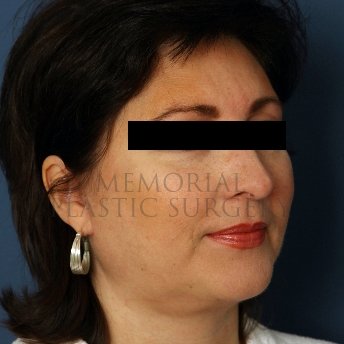 A oblique view after photo of patient 235 that underwent Face Lift procedures at Memorial Plastic Surgery