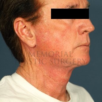 A oblique view after photo of patient 237 that underwent Face Lift procedures at Memorial Plastic Surgery