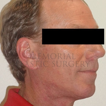 A oblique view after photo of patient 180 that underwent Face Lift procedures at Memorial Plastic Surgery