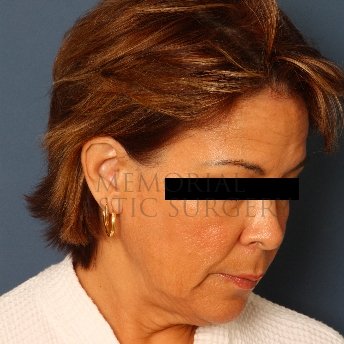 A oblique view before photo of patient 234 that underwent Face Lift procedures at Memorial Plastic Surgery