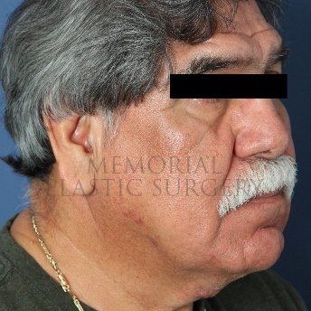 A oblique view before photo of patient 238 that underwent Face Lift procedures at Memorial Plastic Surgery