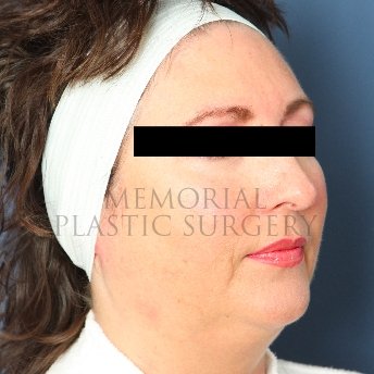 A oblique view before photo of patient 235 that underwent Face Lift procedures at Memorial Plastic Surgery