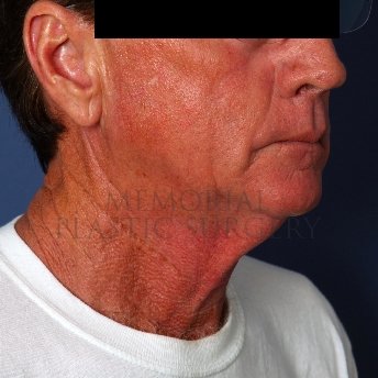 A oblique view before photo of patient 237 that underwent Face Lift procedures at Memorial Plastic Surgery