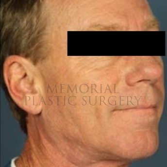 A oblique view before photo of patient 180 that underwent Face Lift procedures at Memorial Plastic Surgery