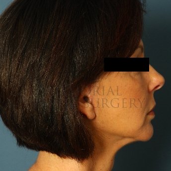 A side view after photo of patient 236 that underwent Face Lift procedures at Memorial Plastic Surgery