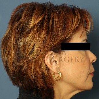 A side view after photo of patient 234 that underwent Face Lift procedures at Memorial Plastic Surgery