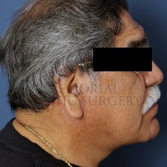A side view after photo of patient 238 that underwent Face Lift procedures at Memorial Plastic Surgery