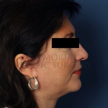 A side view after photo of patient 235 that underwent Face Lift procedures at Memorial Plastic Surgery