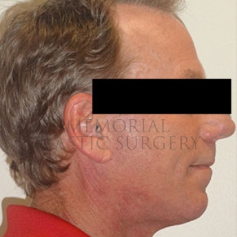 A side view after photo of patient 180 that underwent Face Lift procedures at Memorial Plastic Surgery
