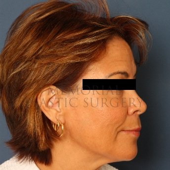 A side view before photo of patient 234 that underwent Face Lift procedures at Memorial Plastic Surgery
