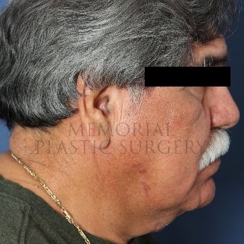 A side view before photo of patient 238 that underwent Face Lift procedures at Memorial Plastic Surgery
