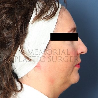 A side view before photo of patient 235 that underwent Face Lift procedures at Memorial Plastic Surgery