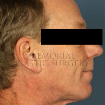A side view before photo of patient 180 that underwent Face Lift procedures at Memorial Plastic Surgery
