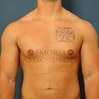 A front view after photo of patient 209 that underwent Gynecomastia procedures at Memorial Plastic Surgery