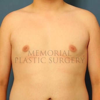 A front view after photo of patient 211 that underwent Gynecomastia procedures at Memorial Plastic Surgery