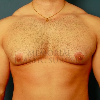 A front view after photo of patient 210 that underwent Gynecomastia procedures at Memorial Plastic Surgery