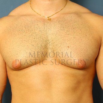 A front view before photo of patient 210 that underwent Gynecomastia procedures at Memorial Plastic Surgery