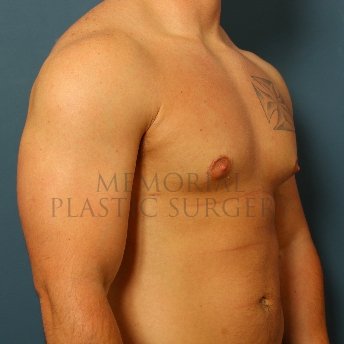 A oblique view after photo of patient 209 that underwent Gynecomastia procedures at Memorial Plastic Surgery