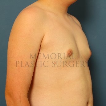 A oblique view after photo of patient 211 that underwent Gynecomastia procedures at Memorial Plastic Surgery