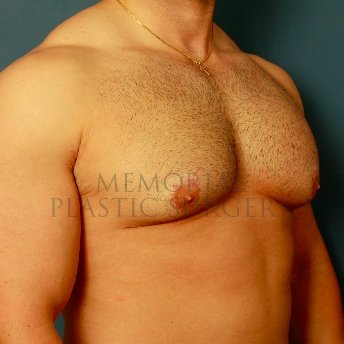 A oblique view after photo of patient 210 that underwent Gynecomastia procedures at Memorial Plastic Surgery