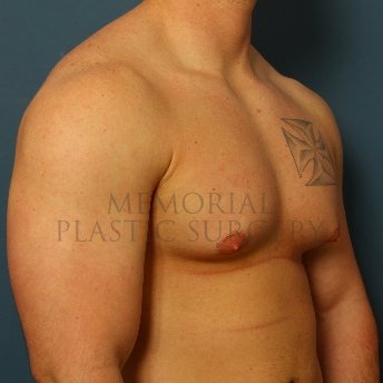 A oblique view before photo of patient 209 that underwent Gynecomastia procedures at Memorial Plastic Surgery
