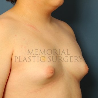 A oblique view before photo of patient 211 that underwent Gynecomastia procedures at Memorial Plastic Surgery