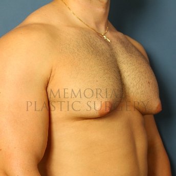 A oblique view before photo of patient 210 that underwent Gynecomastia procedures at Memorial Plastic Surgery