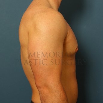 A side view after photo of patient 209 that underwent Gynecomastia procedures at Memorial Plastic Surgery