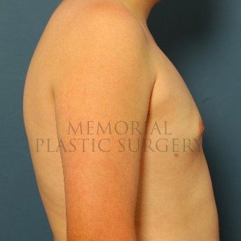 A side view after photo of patient 211 that underwent Gynecomastia procedures at Memorial Plastic Surgery