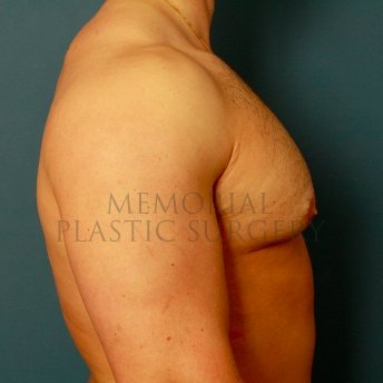 A side view after photo of patient 210 that underwent Gynecomastia procedures at Memorial Plastic Surgery