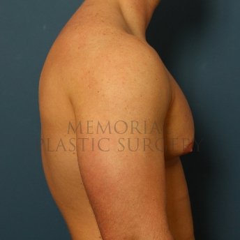 A side view before photo of patient 209 that underwent Gynecomastia procedures at Memorial Plastic Surgery