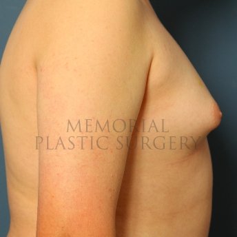 A side view before photo of patient 211 that underwent Gynecomastia procedures at Memorial Plastic Surgery