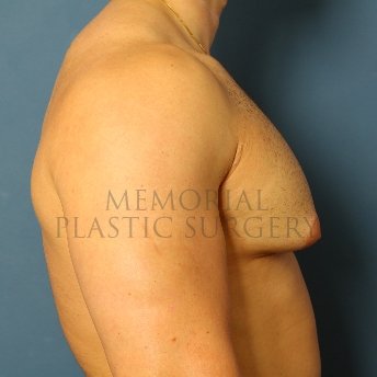A side view before photo of patient 210 that underwent Gynecomastia procedures at Memorial Plastic Surgery