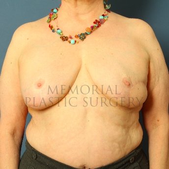 A front view after photo of patient 213 that underwent Latissimus Muscle procedures at Memorial Plastic Surgery