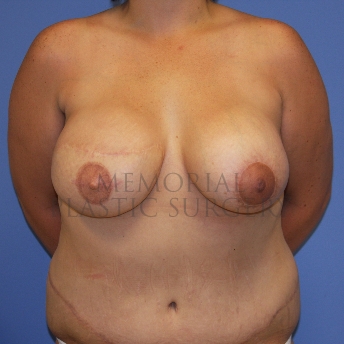 A front view after photo of patient 768 that underwent Latissimus Muscle procedures at Memorial Plastic Surgery