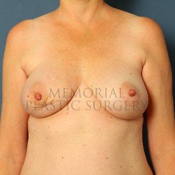 A front view before photo of patient 212 that underwent Latissimus Muscle procedures at Memorial Plastic Surgery