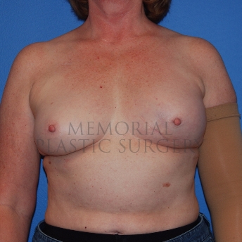 A front view before photo of patient 769 that underwent Latissimus Muscle procedures at Memorial Plastic Surgery