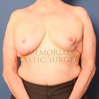 A front view before photo of patient 213 that underwent Latissimus Muscle procedures at Memorial Plastic Surgery