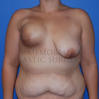A front view before photo of patient 768 that underwent Latissimus Muscle procedures at Memorial Plastic Surgery