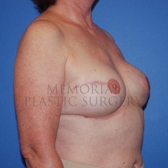 A oblique view after photo of patient 769 that underwent Latissimus Muscle procedures at Memorial Plastic Surgery