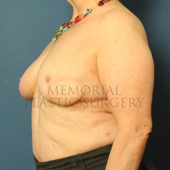 A oblique view after photo of patient 213 that underwent Latissimus Muscle procedures at Memorial Plastic Surgery