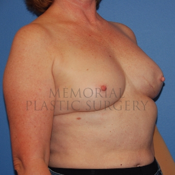 A oblique view before photo of patient 769 that underwent Latissimus Muscle procedures at Memorial Plastic Surgery