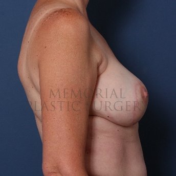 A side view after photo of patient 212 that underwent Latissimus Muscle procedures at Memorial Plastic Surgery