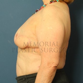 A side view after photo of patient 213 that underwent Latissimus Muscle procedures at Memorial Plastic Surgery