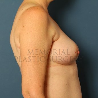 A side view before photo of patient 212 that underwent Latissimus Muscle procedures at Memorial Plastic Surgery